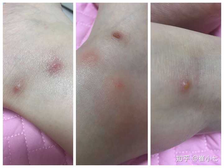 怎样除跳骚_怎样除跳骚_怎样除跳骚